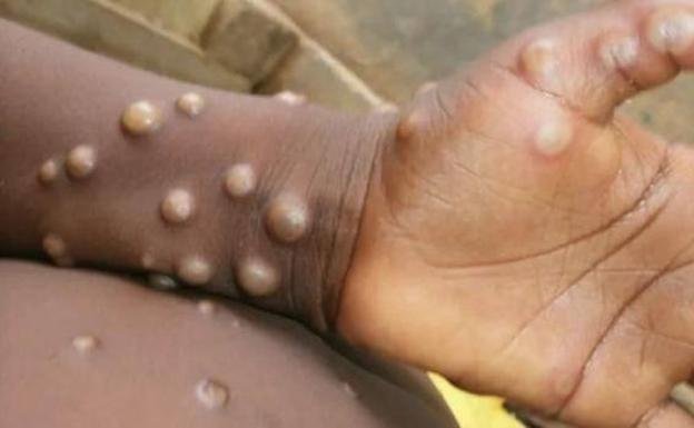 viruela-mono-kTeC-U170858745171bCD-624x385@El Correo