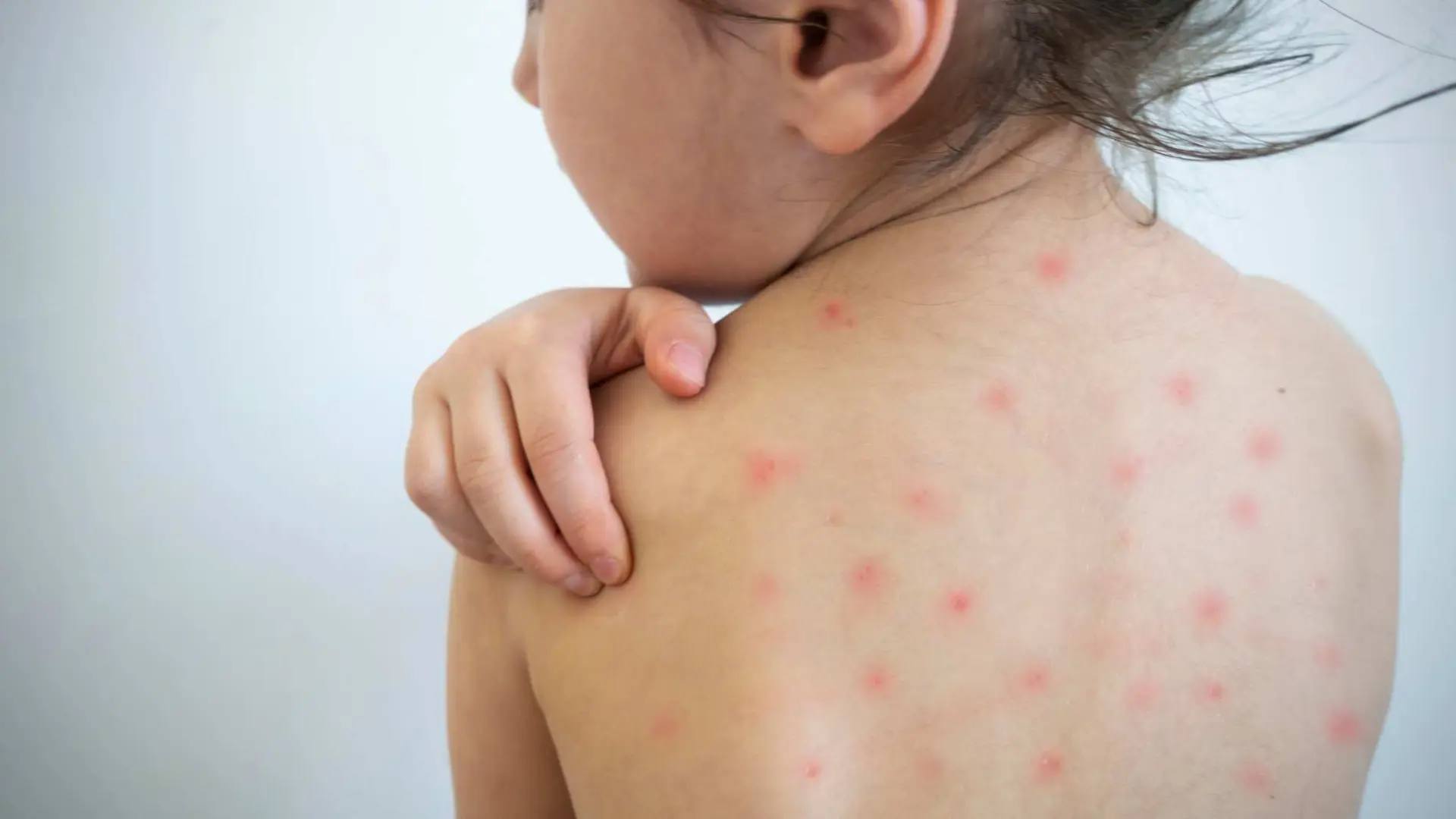 Se disparan casos de varicela en la Península yucateca