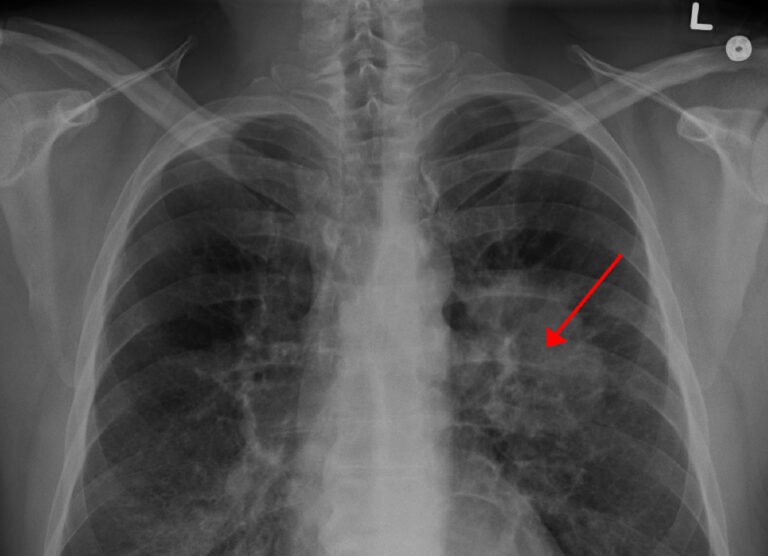 LungCACXR