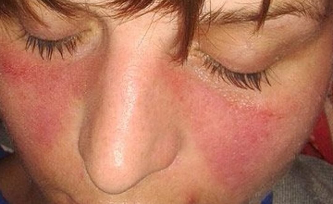 Estudio de Stanford vincula el virus Epstein Barr con la mayoría de casos de lupus